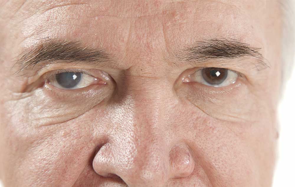 Cataracte : symptômes et traitement